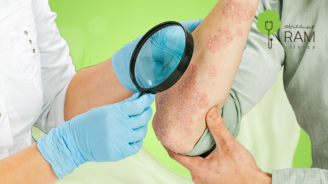 أدوية جلدية أصلية مثل كريمات حب الشباب ومحاليل تساقط الشعر معروضة في صيدلية عمان الاردن مع روشتة طبية وعدسات لاصقة – jordan pharmacy online.